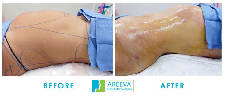 Areeva-Clinic - Liposuction-3