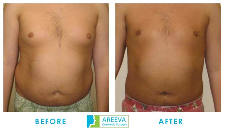 Areeva-Clinic - Liposuction-9