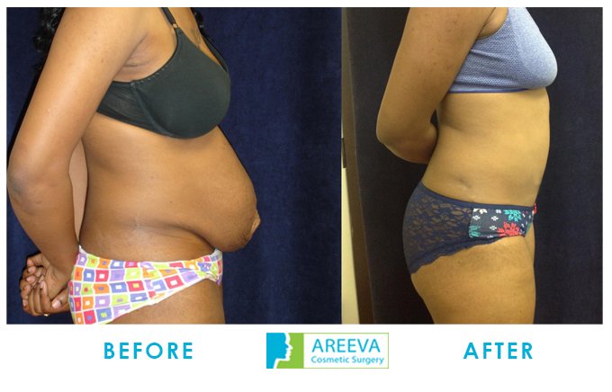 Areeva-Clinic - Tummy-Tuck-1